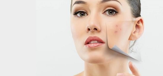 Treats Acne