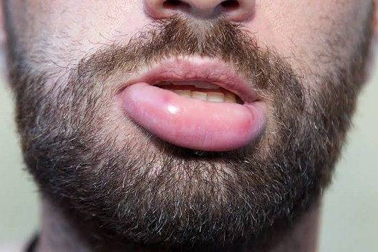 How to get rid of a fat lip1