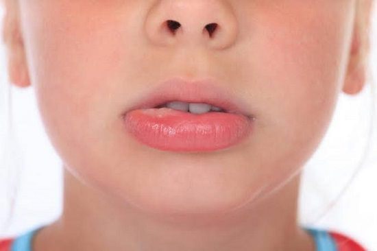 How to get rid of a fat lip3
