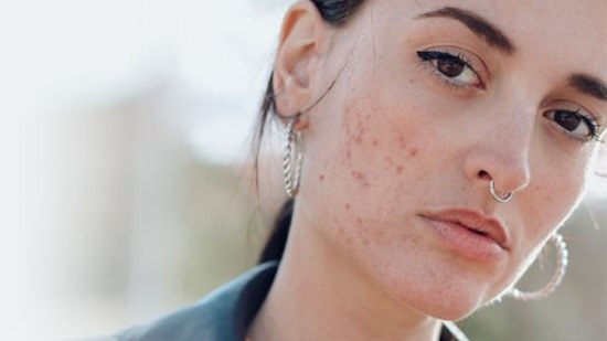 Fights Acne