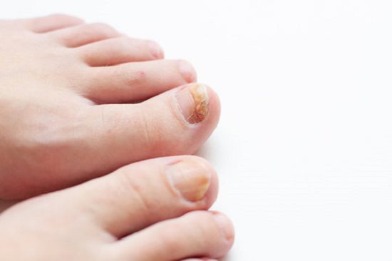 nail-fungus-onychomycosis-universal-dermatology