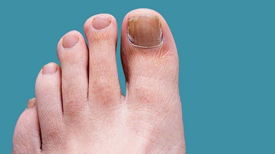 Hydrogen Peroxide for Toenail Fungus1