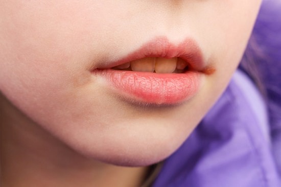 People Susceptible To Angular Cheilitis